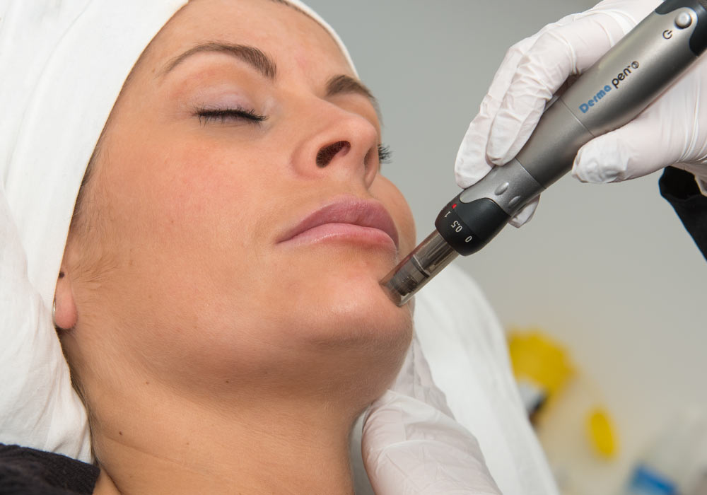 Dermapen (micro needling)