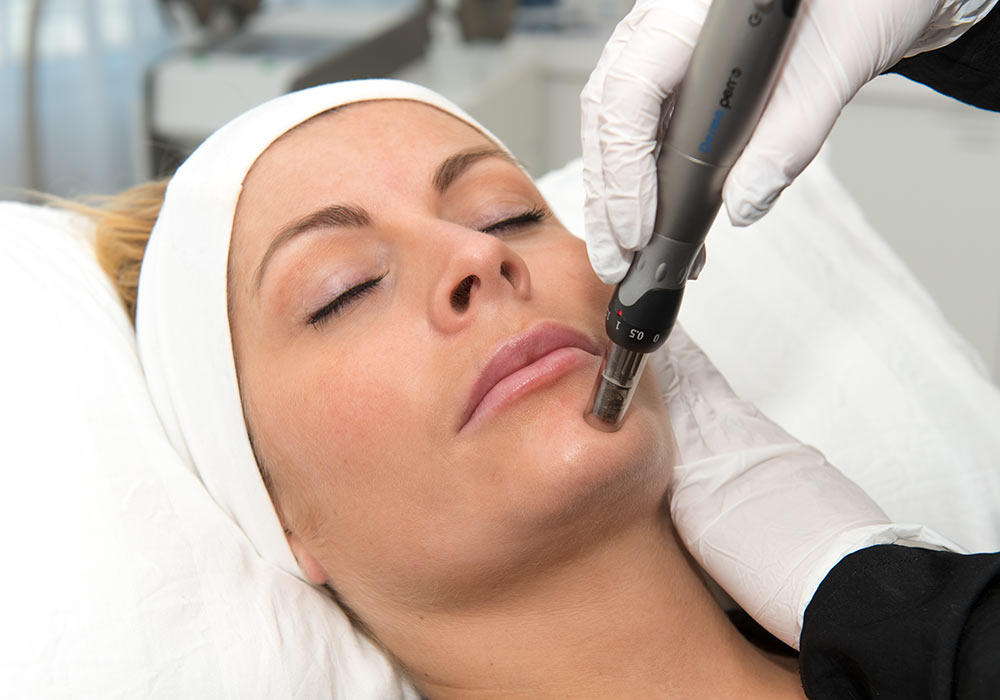 Dermapen (micro needling) Oslo